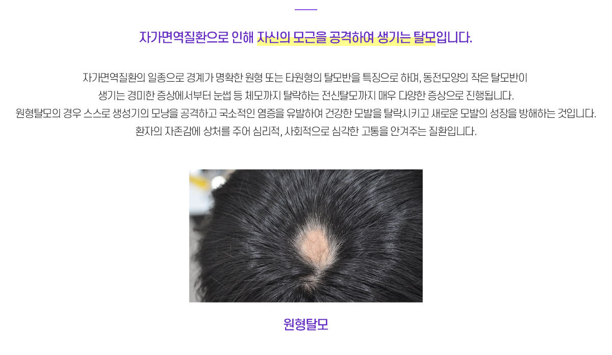 원형탈모란