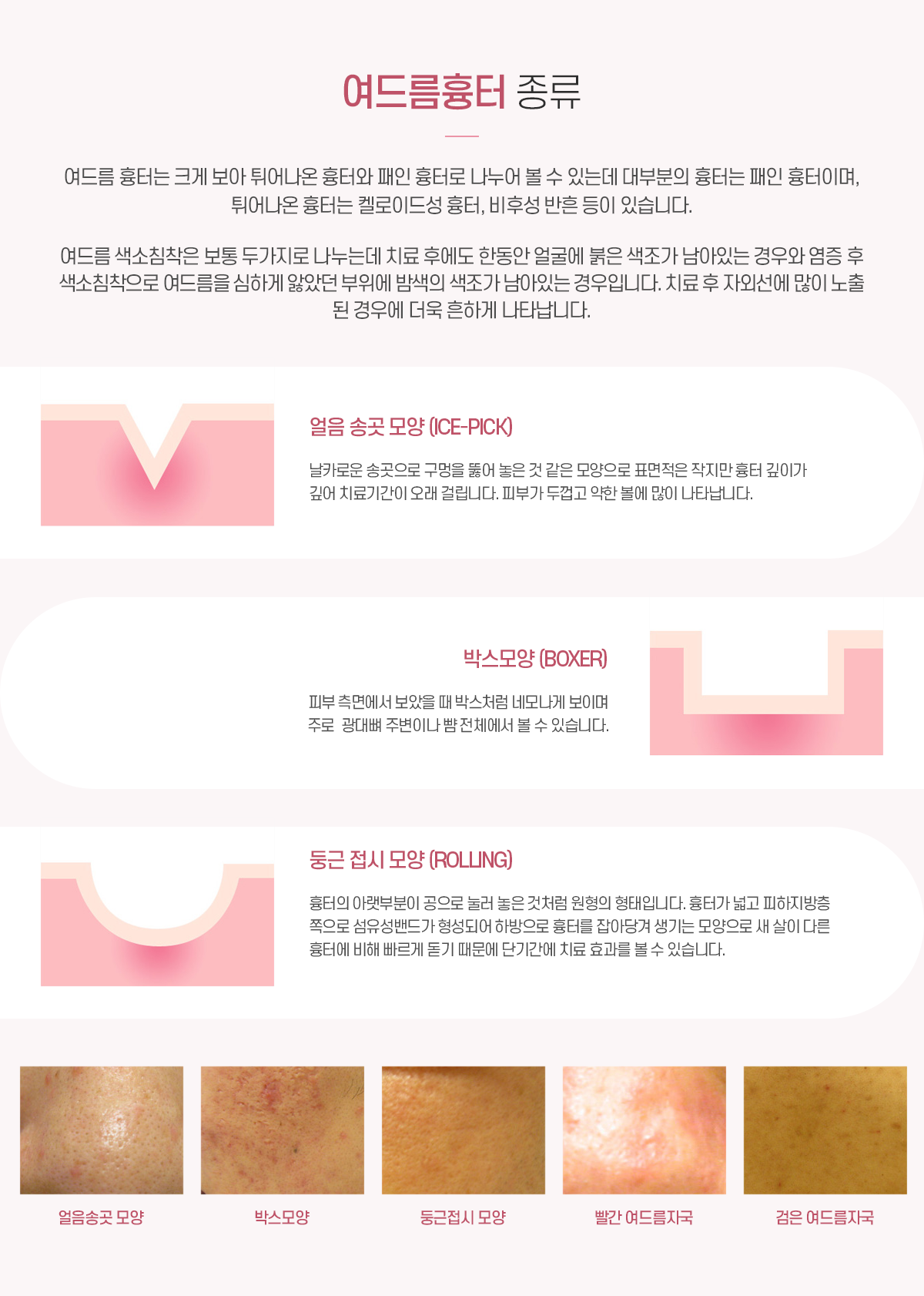 여드름흉터의 종류